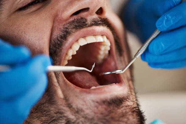 Best Emergency Wisdom Teeth Removal in Maxton, NC